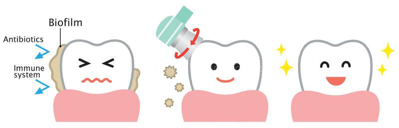 dental-biofilm-removal-cute-cartoon-illustration-health-oral-care-concept-professional-tooth-cleaning-remove-hygiene