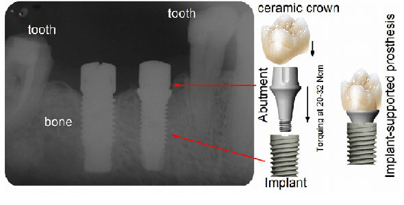 Schematics-of-a-titanium-based-abutment-implant-joint