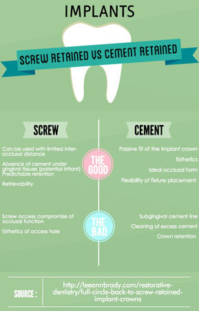 Screw Retained Vs Cement Retained Implant Crowns