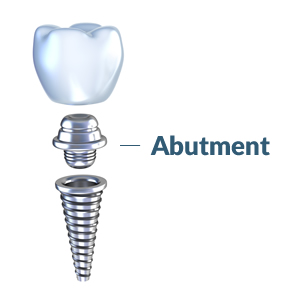 abutment-1