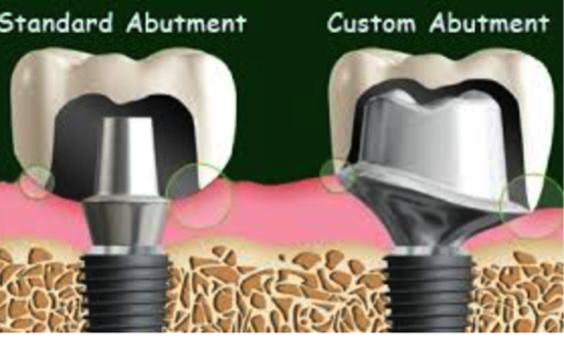 abutments