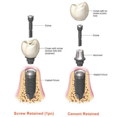 bonding the implant crowns