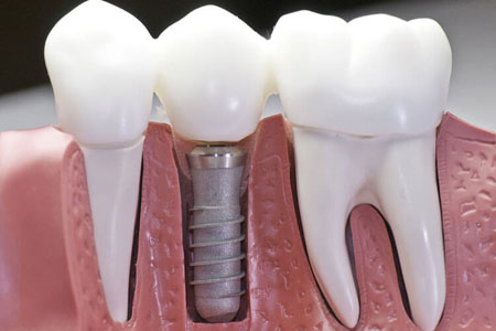 dental-implant-crown