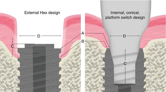 pre-implant-tissue-abutment