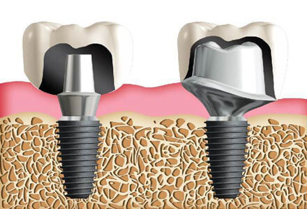 stock-abutments