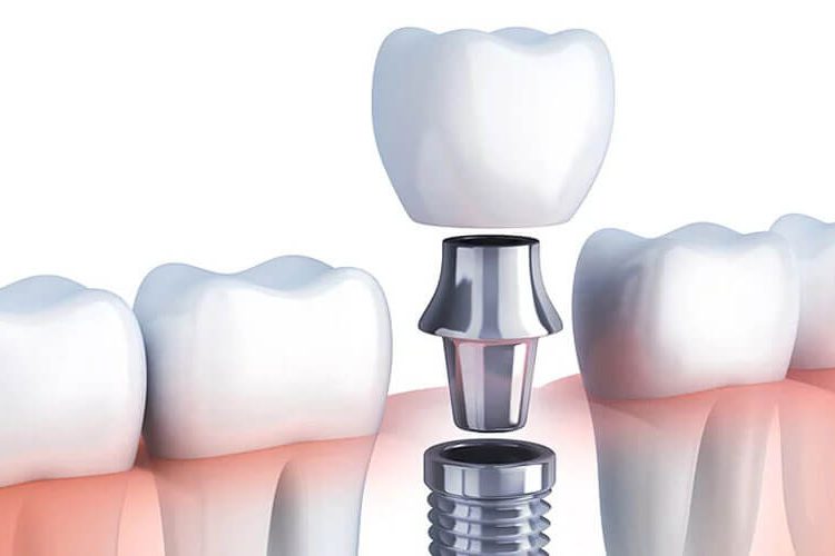 tooth implant