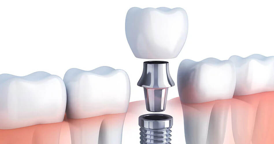 tooth implant