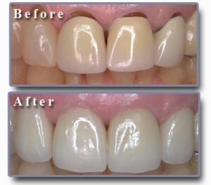 zirconium veneers