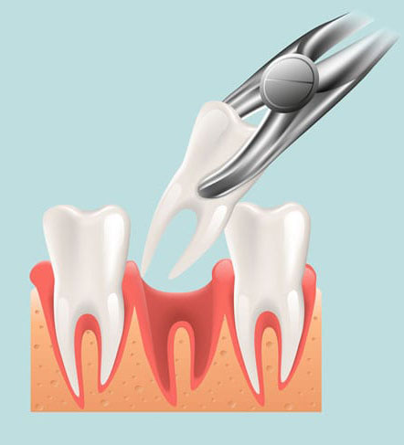 Tooth-Extraction-explained