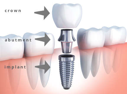 dental-implant-parts