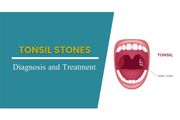 diagnosis and treatment for a tonsil stone