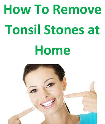 remove tonsil stones at home