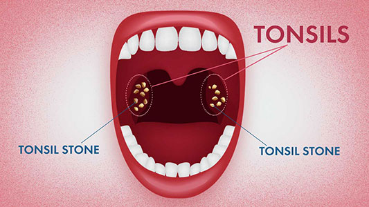 tonsil-stones-new