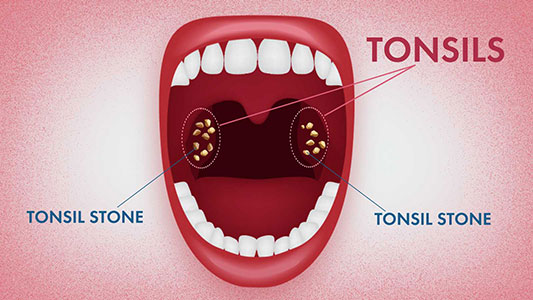 tonsil stone removal