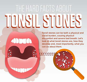 tonsil-stones