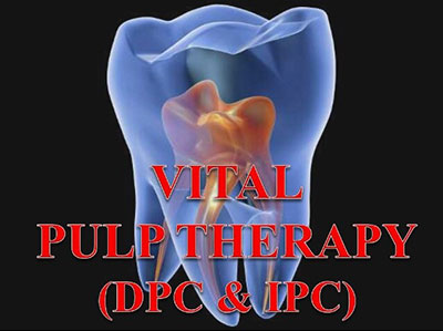 vital-pulp-therapy