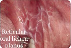 oral lichen planus