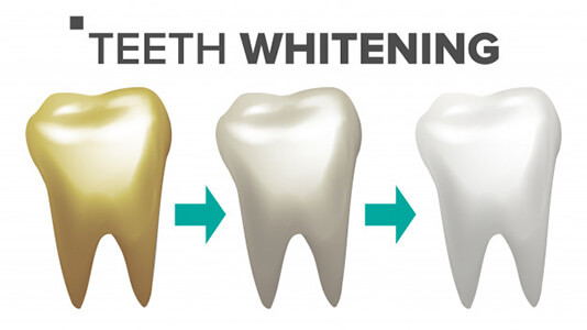 teeth-whitening