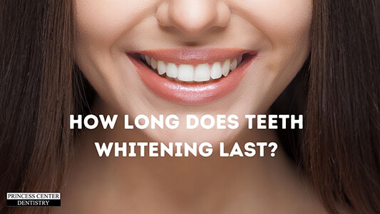 how-long-does-teeth-whitening-last