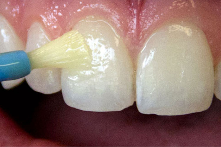 teeth undergoing fluoride varnish procedure