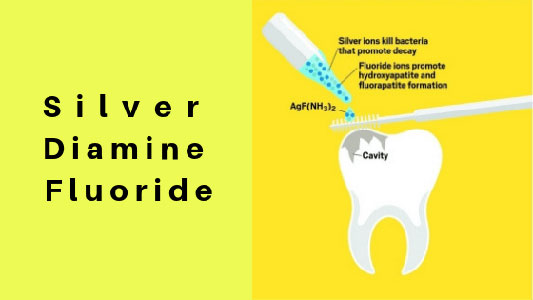 Silver-Diamine-Fluoride