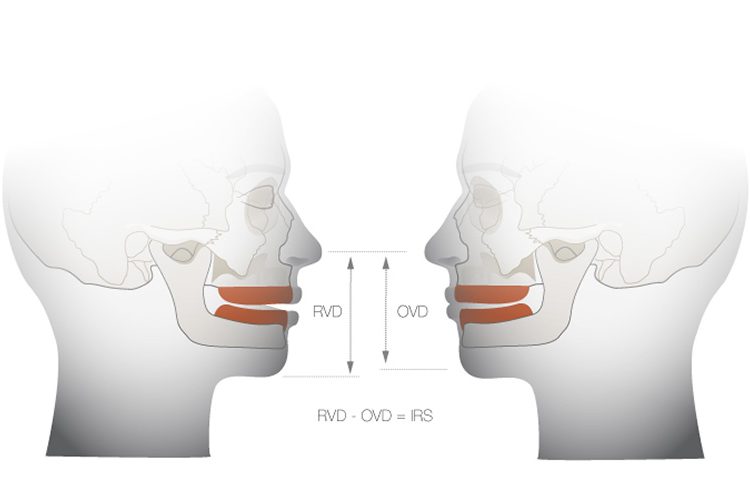 3D model of a mouth with RVD and OVD