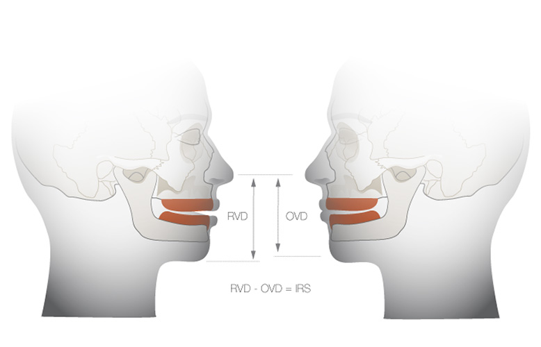 3D model of a mouth with RVD and OVD