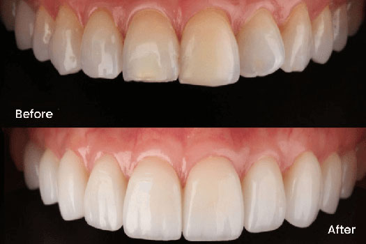 Porcelain-Veneers