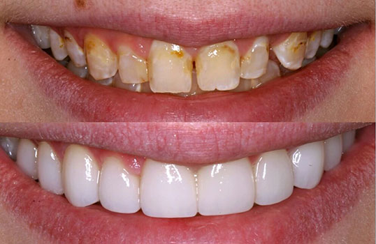 Veneers1