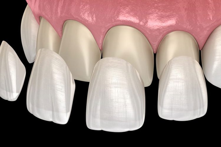 applying porcelain veneers on teeth