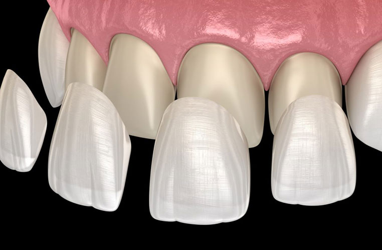 applying porcelain veneers on teeth