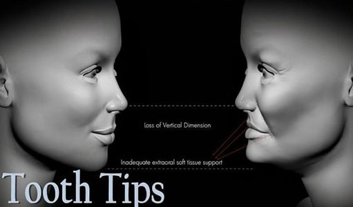 Key Considerations when Treating a Collapsed Jaw