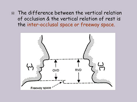 The+difference+between+the+vertical+relation+of+occlusion+&+the+vertical+relation+of+rest+is+the+inter-occlusal+space+or+freeway+space.