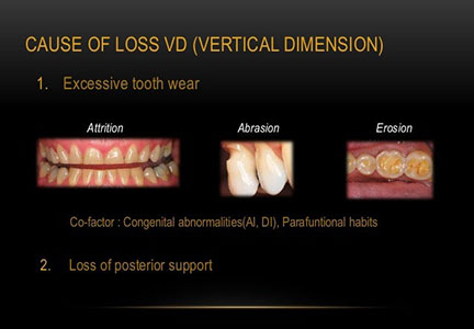 diagnosis-and-treatment-of-choice-in-restoring-vertical-dimension-3-638