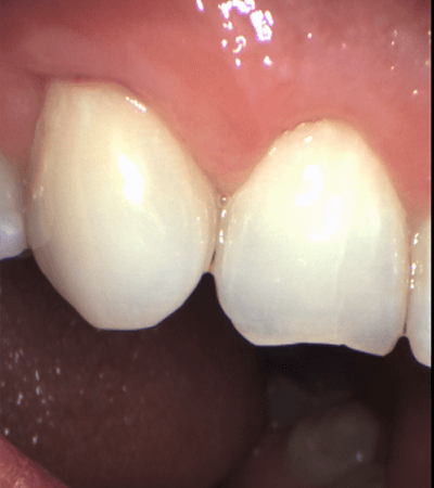 a close-up of a person's teeth