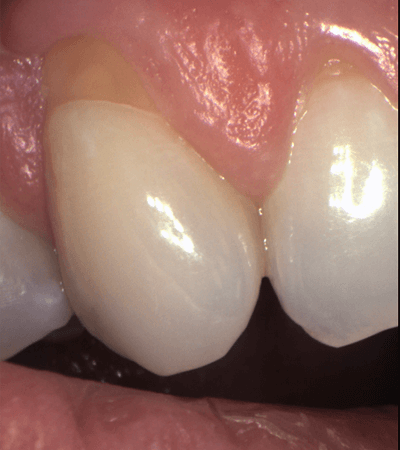 a teeth with a plaque