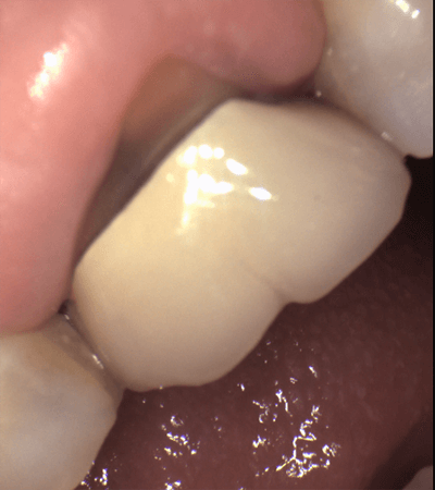 close-up image of a damage teeth