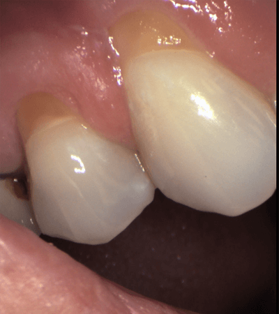 a close-up of a person's teeth with plaque on them