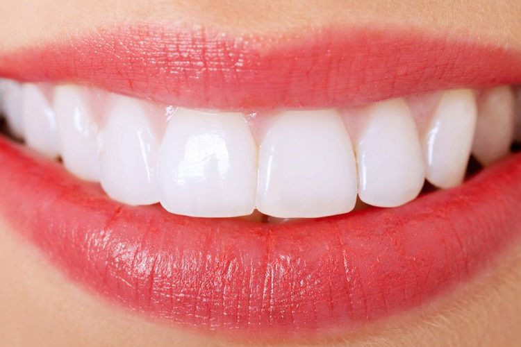 a person’s teeth with veneers installed