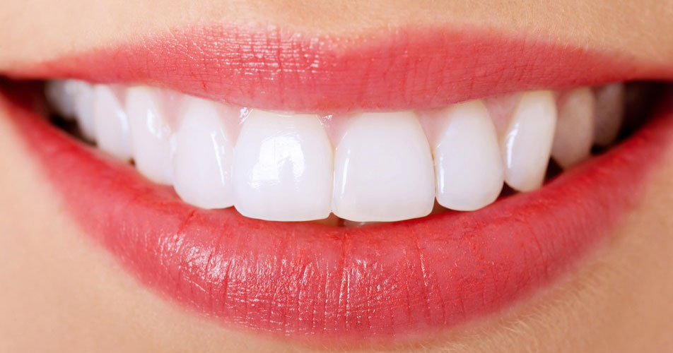 a person’s teeth with veneers installed