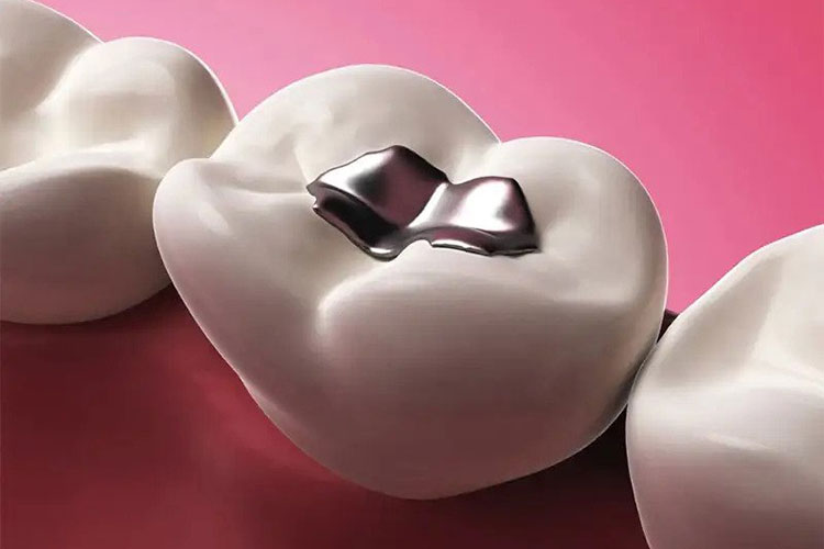 tooth with dental fillings