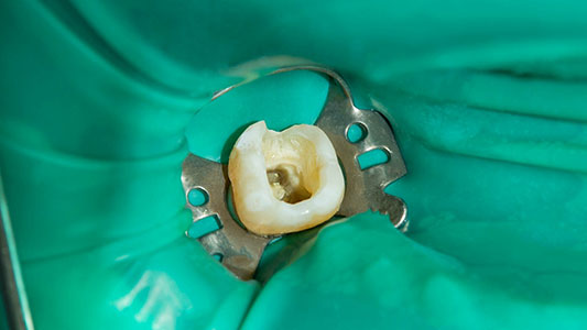 Endodontists-stress-importance-of-closing-dental-dam-gap_2000-x-1125_final