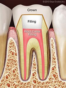 after-root-canal-treatment
