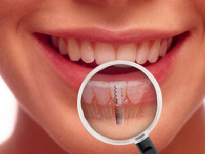 a woman looking at her teeth implant through a magnifying glass