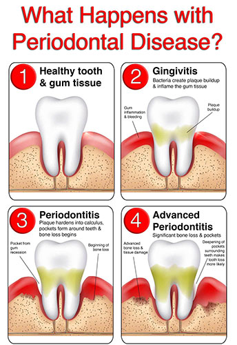 periodontitis-chart-web