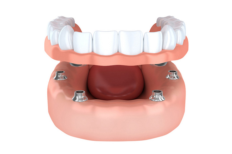 attaching screws to the denture supported by dental implants.
